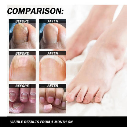 Nail Fungus Serum